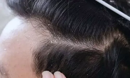 सिर में डैंड्रफ होने से हो गए हैं परेशान? 5 घरेलू तरीके आज़माएं, क्लीन होगा स्कैल्प सिर में डैंड्रफ होने से हो गए हैं परेशान? 5 घरेलू तरीके आज़माएं, क्लीन होगा स्कैल्प