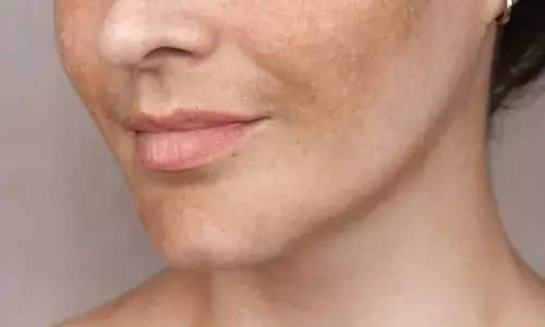 Face freckles home remedies Face freckles home remedies