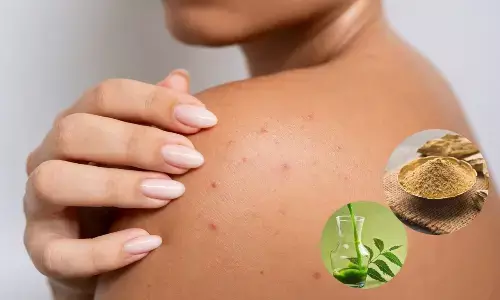 गर्मी में चुभने लगी हैं घमौरियां? घबराएं नहीं, इन 5 घरेलू नुस्खों से पाएं छुटकारा