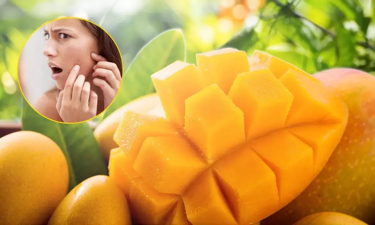 गर्मी में ज्यादा आम खाने से हो सकते हैं पिंपल्स और छाले, इन लोगों को रखना चाहिए खास परहेज