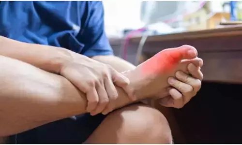 high uric acid home remedies