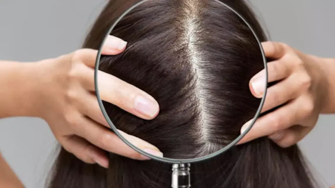 how to remove dandruff in monsoon