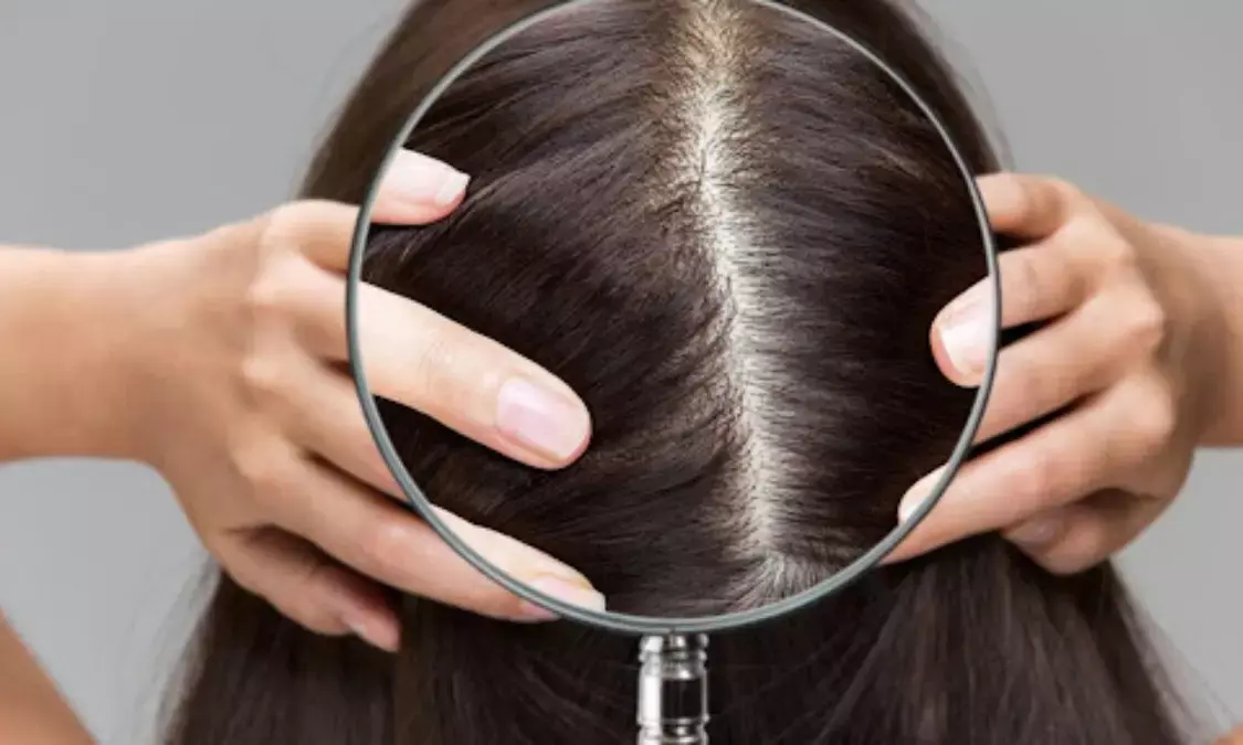 how to remove dandruff in monsoon how to remove dandruff in monsoon