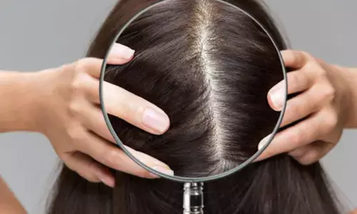 how to remove dandruff in monsoon