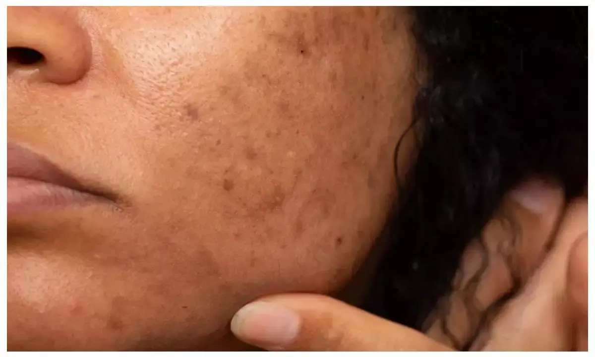 potato juice for dark spots potato juice for dark spots