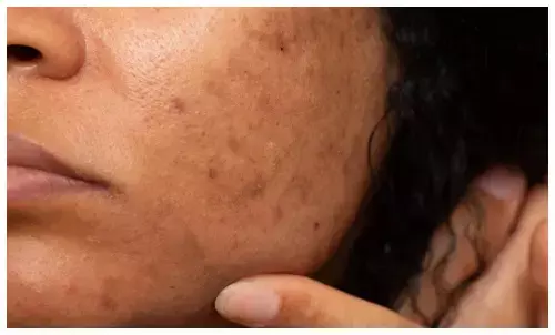 potato juice for dark spots