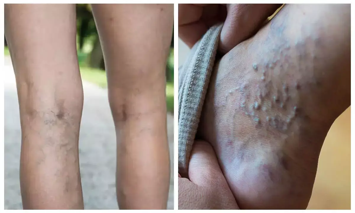 varicose veins home remedies