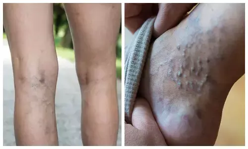 varicose veins home remedies