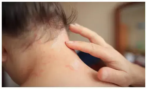 गर्मी-बरसात में घमौरियों और रैशेज से पाना है छुटकारा, अपनाएं ये 4 घरेलू नुस्खे, 100 रुपये से कम में मिलेगी राहत!