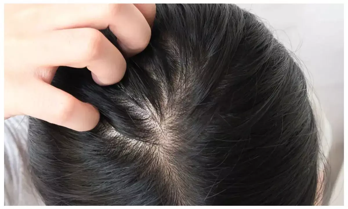 How to treat dandruff in rainy season