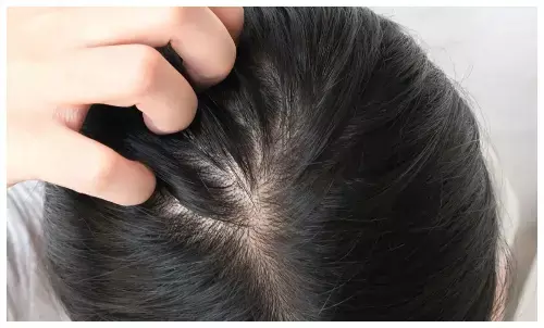How to treat dandruff in rainy season
