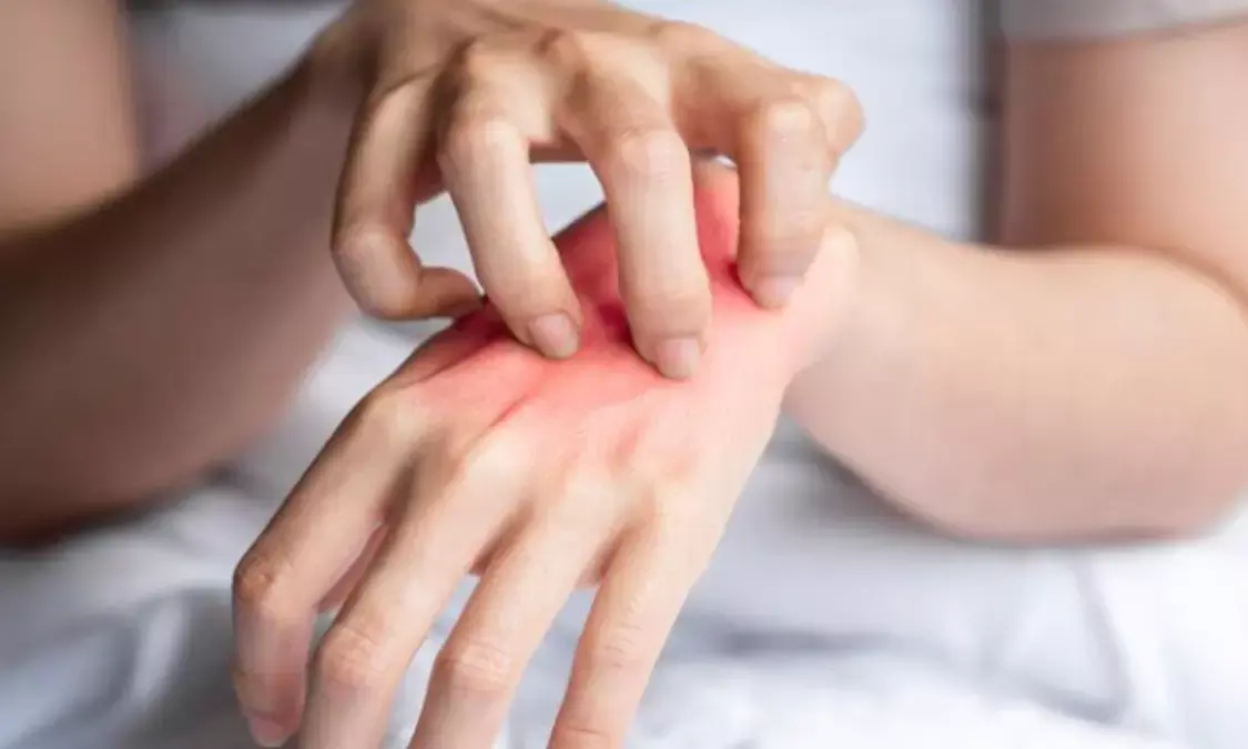 Home Remedies: मॉनसून में स्किन इरिटेशन से मिलेगी राहत, बस नहाने के पानी में मिलाएं ये 5 चीजें