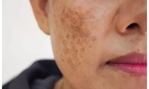 potato juice for dark spots on face