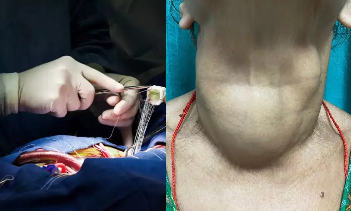 AIIMS Bhopal Goiter Operation, Complex Thyroid Surgery, AIIMS Bhopal Medical Success, Bhopal Medical News,
