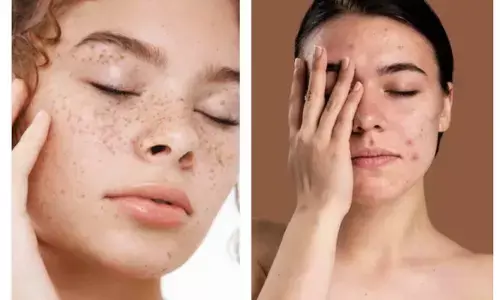 remove freckles and dark patches
