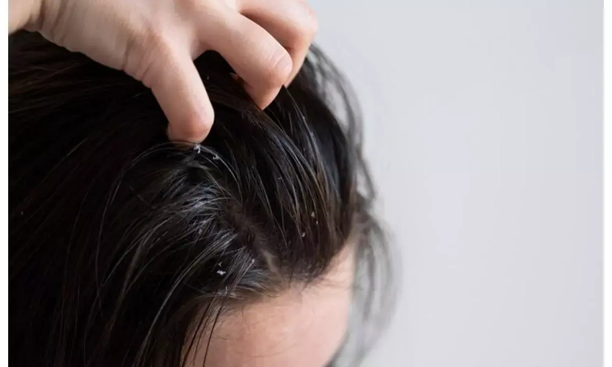 Winter Hair Care Tips