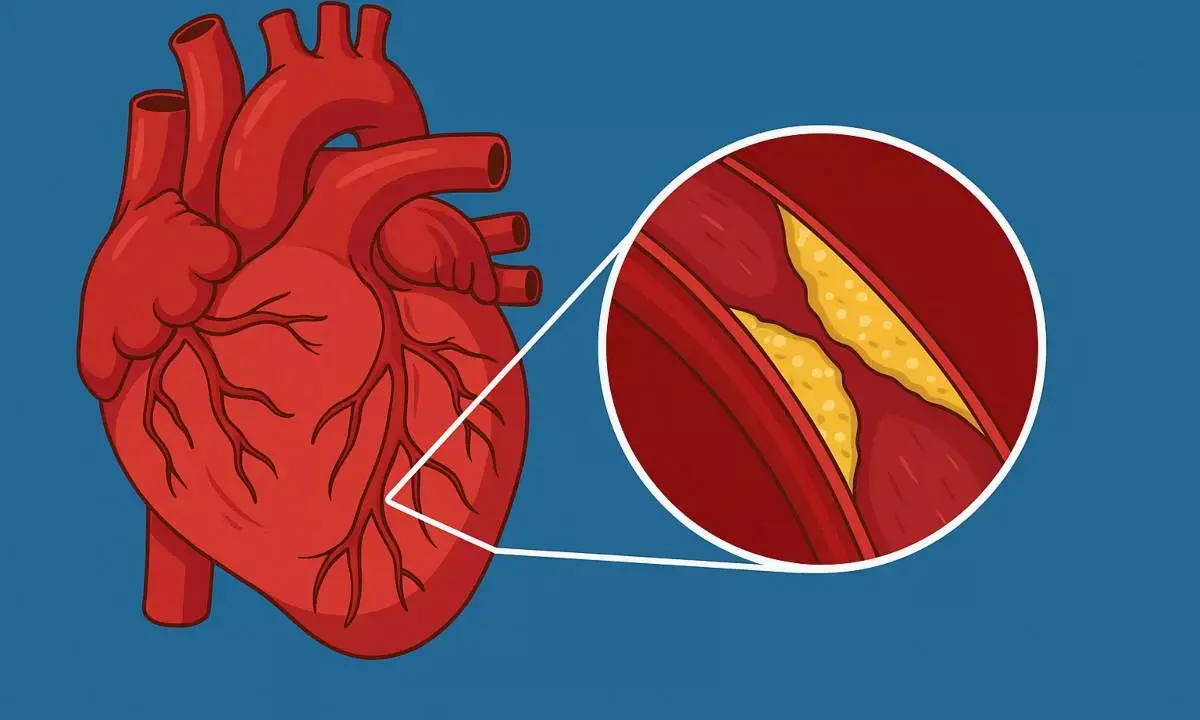 cholesterol home remedies