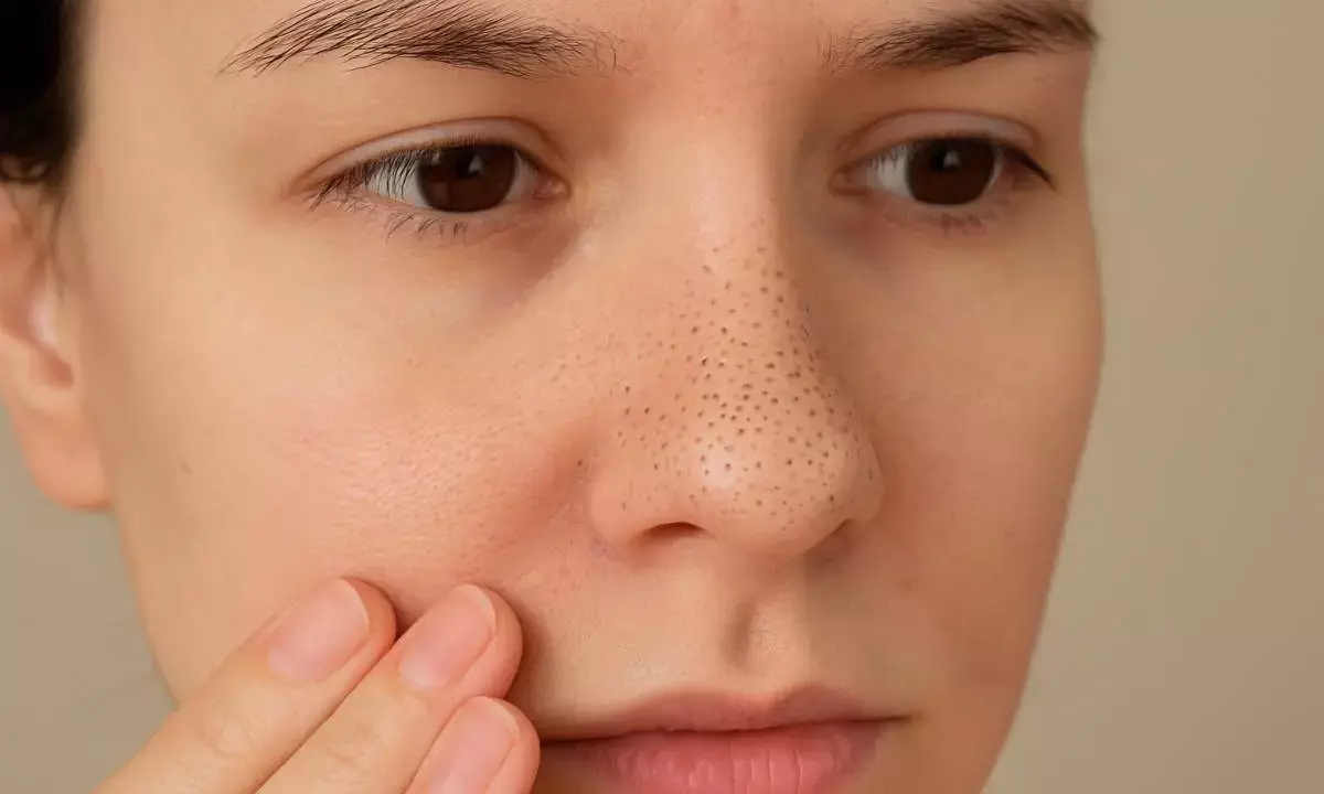 Nose blackheads removing home remedies