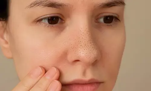 Nose blackheads removing home remedies