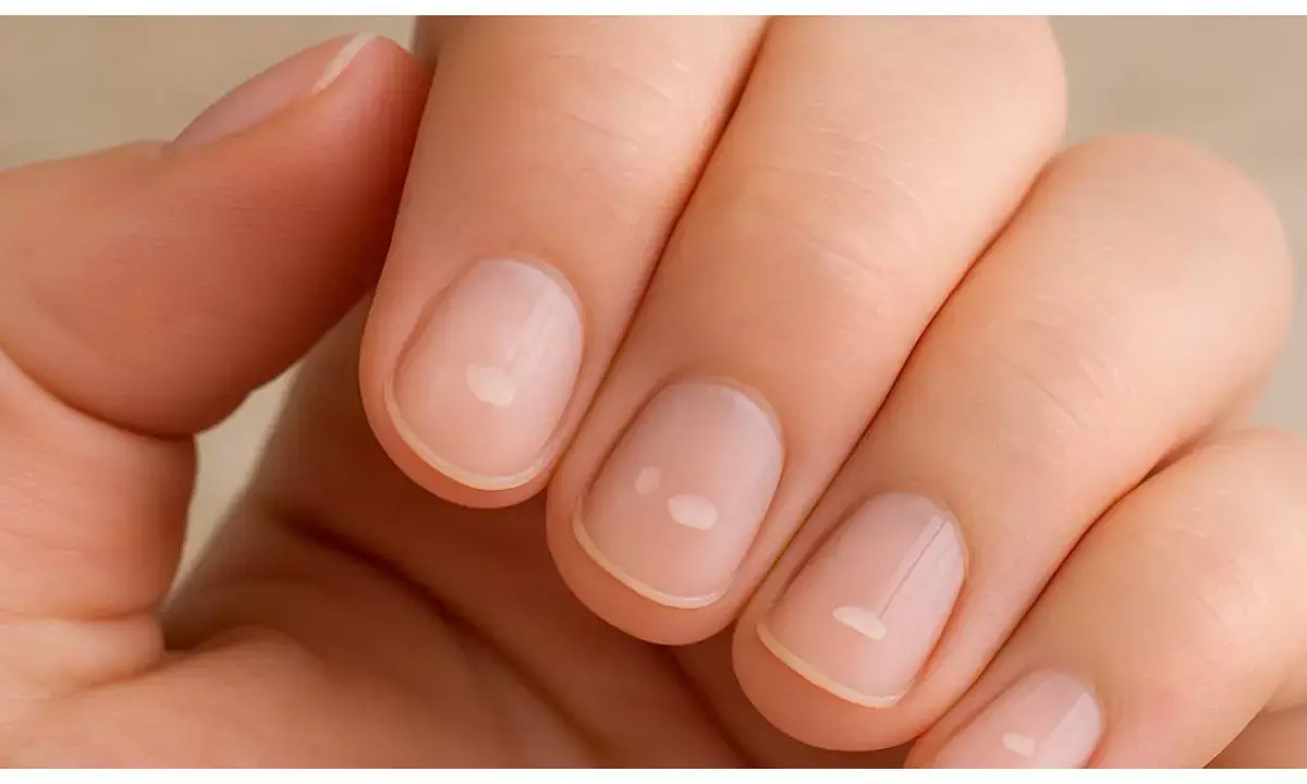 how to eliminate white spots on nails