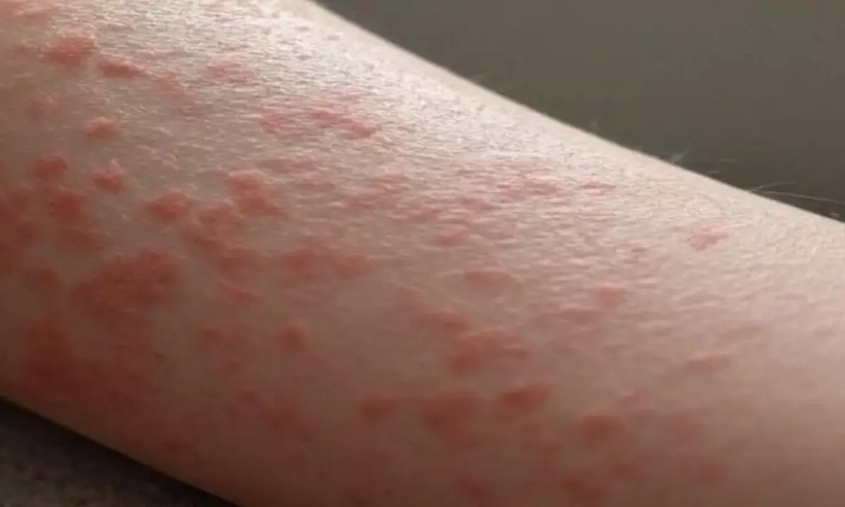 फंगल इन्फेक्शन की दिक्कत दूर करने के उपाय