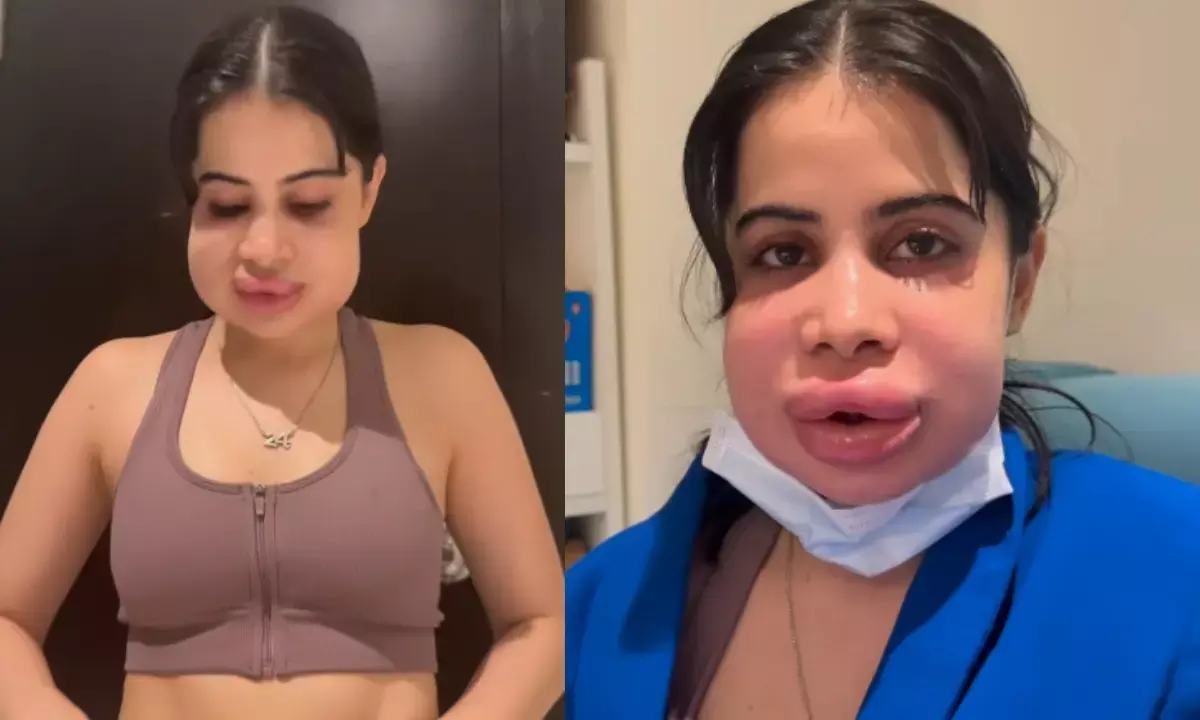 Uorfi Javed Swollen Face after Lip Filler Removal surgery, Video Viral Uorfi Javed Swollen Face after Lip Filler Removal surgery, Video Viral