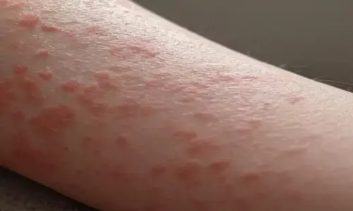 फंगल इन्फेक्शन की दिक्कत दूर करने के उपाय फंगल इन्फेक्शन की दिक्कत दूर करने के उपाय