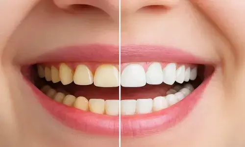 Whitening Teeth home remedies