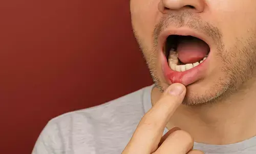 head and neck cancer symptoms head and neck cancer symptoms