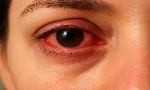 Conjunctivitis Causes symptoms and treatment