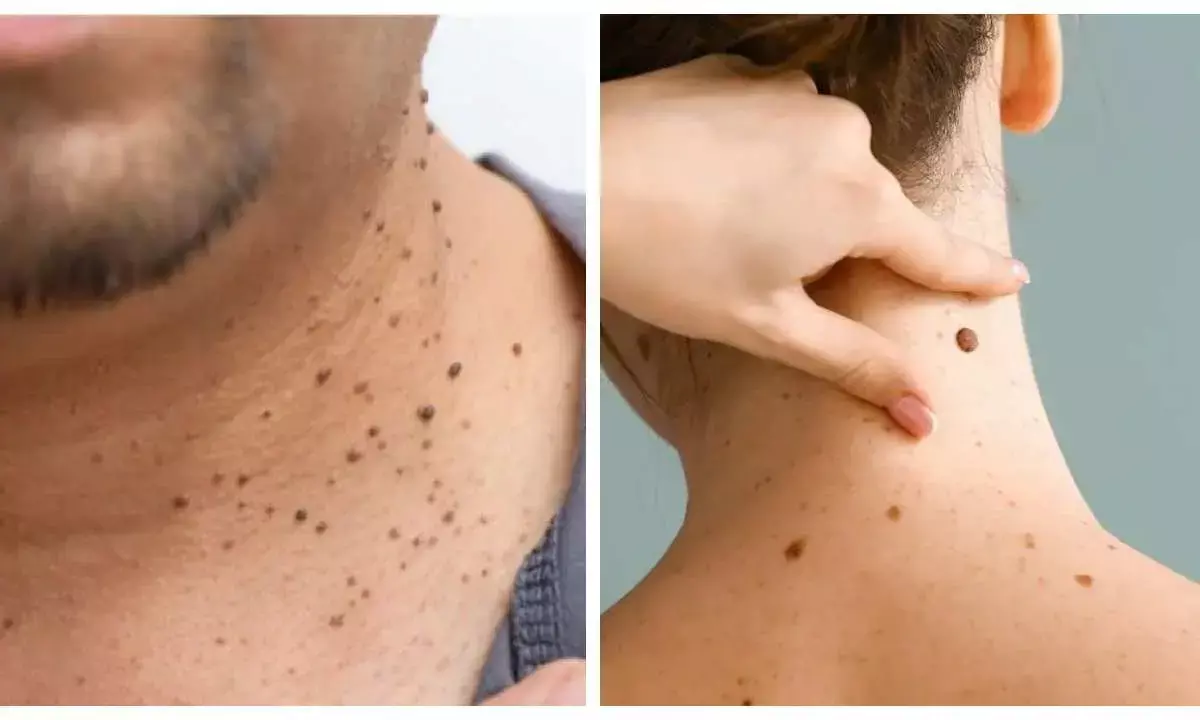 how to remove face and neck warts