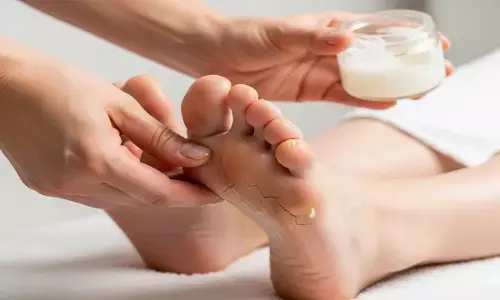 cracked heels home remedies