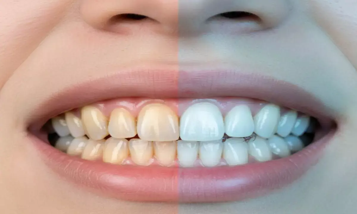 teeth yellowness home remedies daaton ka peelapan door karne ke tarike