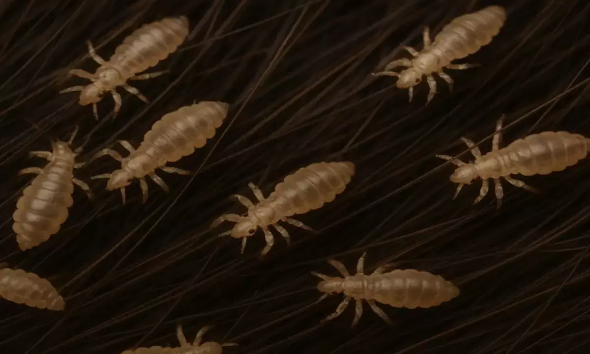 बालों में होने वाले जुएं से पाएं छुटकारा बालों में होने वाले जुएं से पाएं छुटकारा