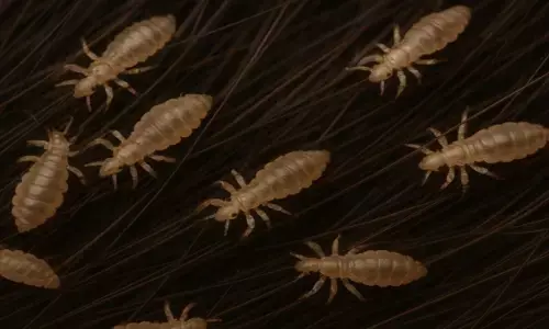 बालों में होने वाले जुएं से पाएं छुटकारा