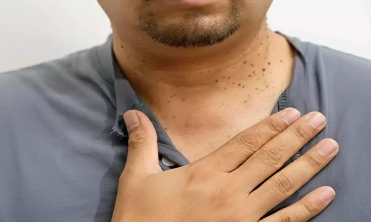 causes of warts around neck