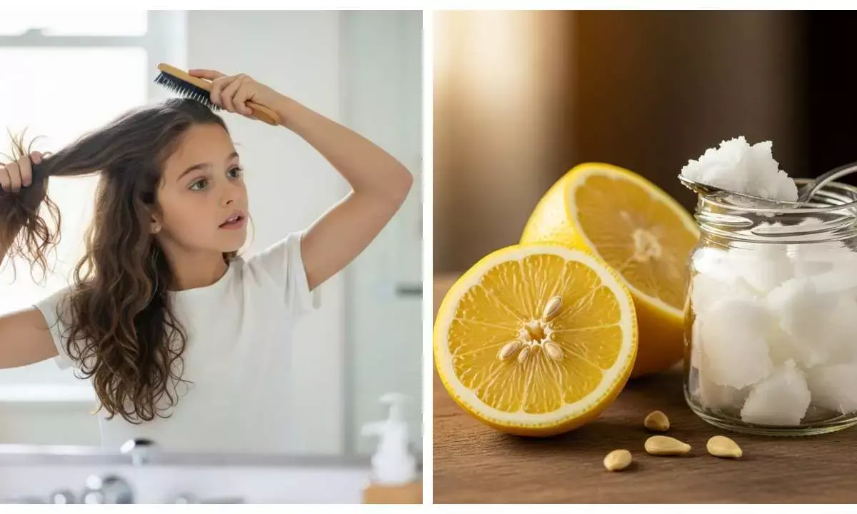 Home remedies for dandruff