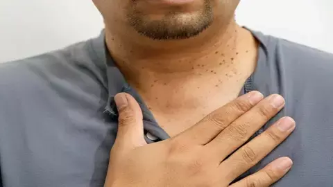 causes of warts around neck