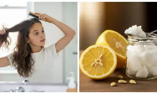 Home remedies for dandruff