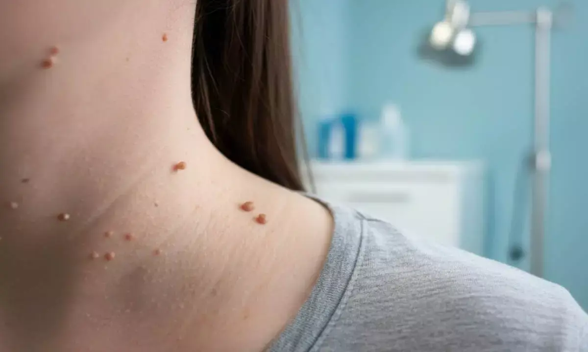 Neck warts early sign of diseases