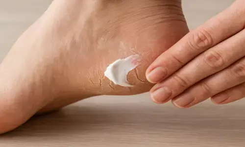 फटी एड़ियों को ठीक करने के उपाय फटी एड़ियों को ठीक करने के उपाय