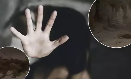 Acid Attack On DU Student