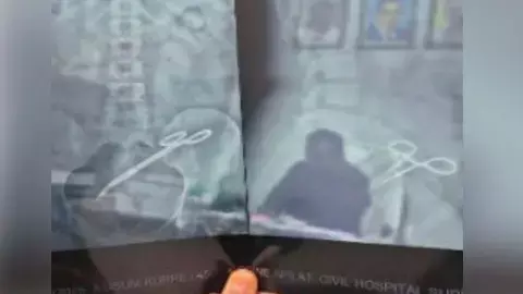 निजी हॉस्पिटल में डॉक्टर ने बरती थी लापरवाही : महिला के पेट में छोड़ दी थी कैंची, पांच साल बाद निकाला