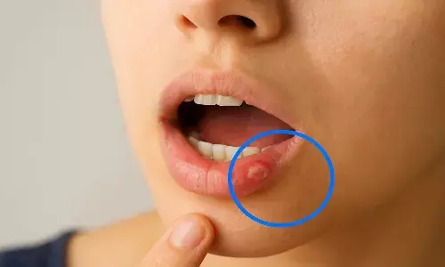 mouth ulcer home remedies