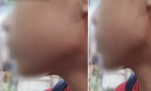 पिटाई के बाद छात्र के गले पर बना निशान।