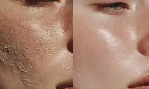 सर्दियों में स्किन की देखभाल सर्दियों में स्किन की देखभाल