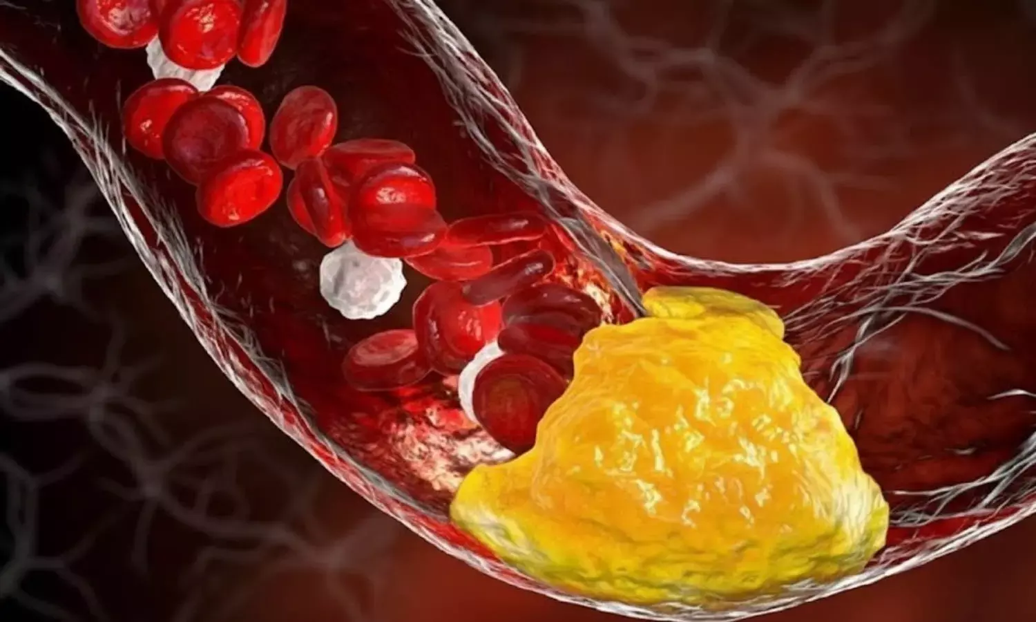 mistakes increase bad cholesterol