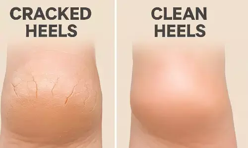 फटी एड़ियां