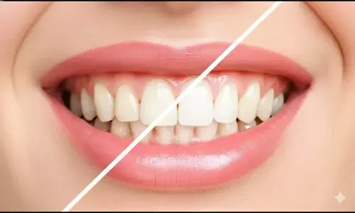 how to remove yellowness of teeth how to remove yellowness of teeth