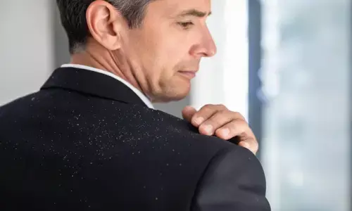 dandruff home remedies dandruff home remedies